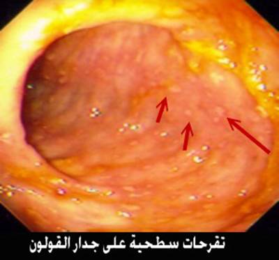���� Crohn`s Disease
